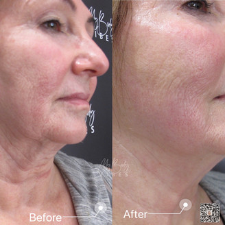 ulfit chin and neck