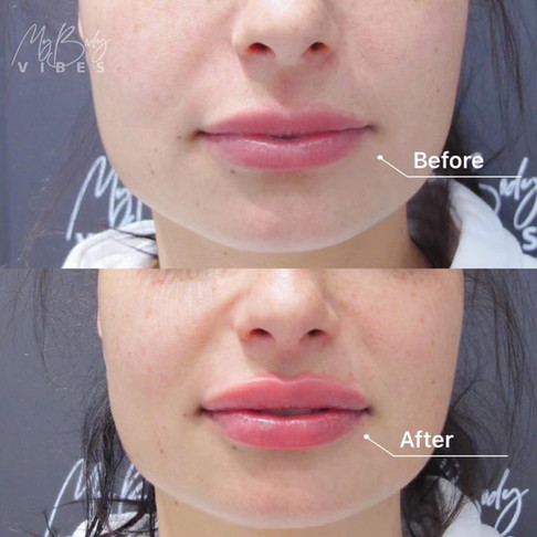 lip filler