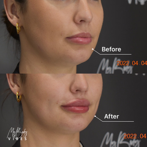 lip filler