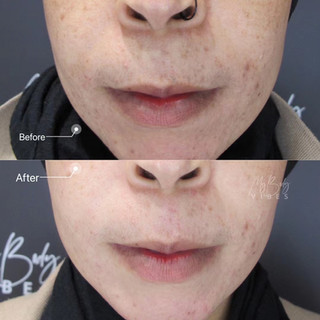 pico laser skin brightening