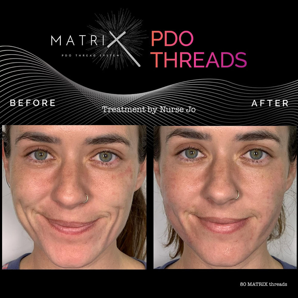Thumbnail: PDO Mono Thread Lifting