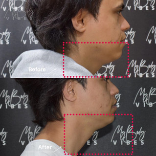 ulfit double chin reduction