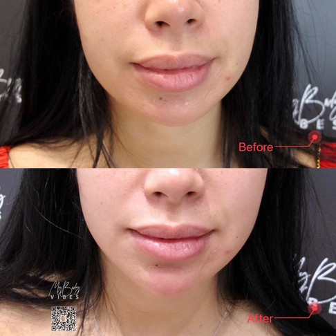 chin filler