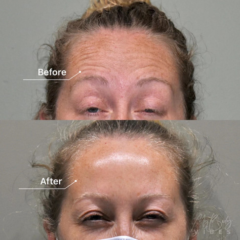 forehead anti-wrinkle