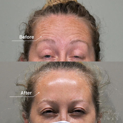 forehead anti-wrinkle