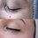 Thumbnail: PRP Therapy (2 Session Deal)