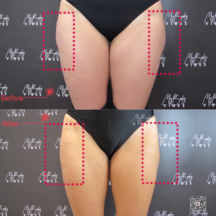 fat freezing on outer thighs