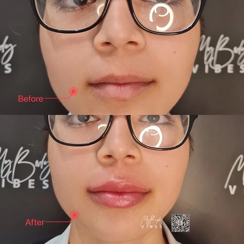 lip filler