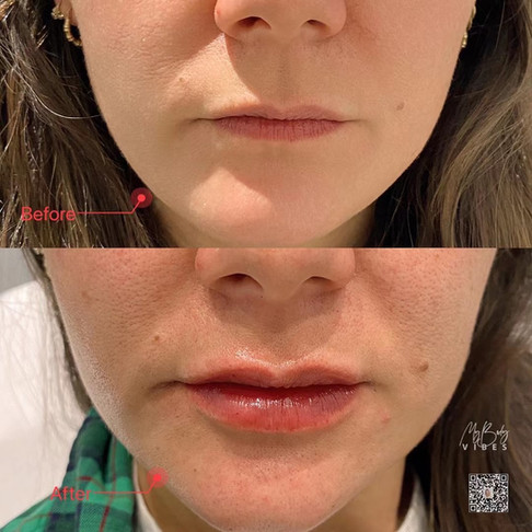lip filler