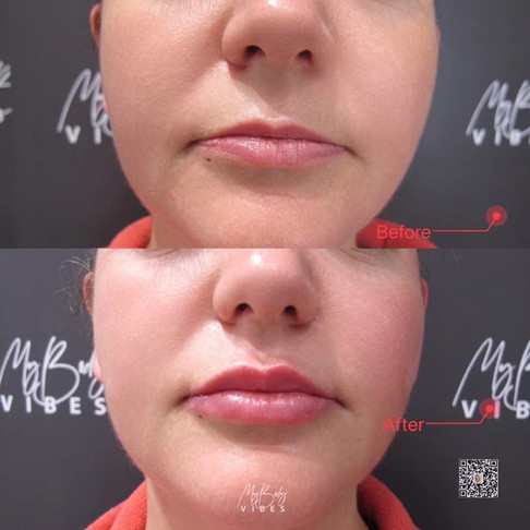 lip filler