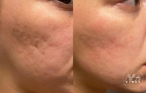 fractional rf micro needling