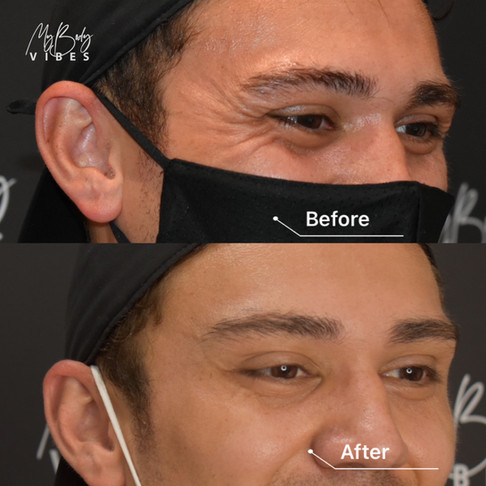 crows feet anti-wrinkle