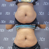 fat freezing on abdomen