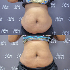 fat freezing on abdomen