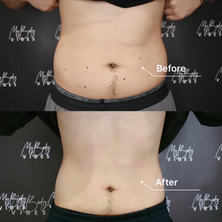 fat freezing on abdomen
