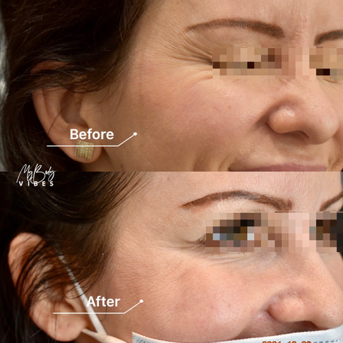 crows feet anti wrinkle