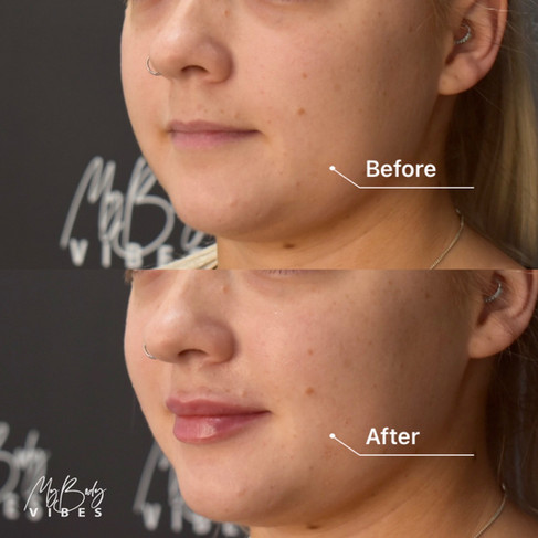 lip filller