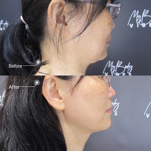 double chin reduction