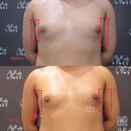 fat freezing male chest