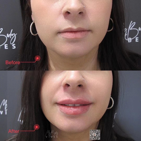 lip filler