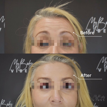 anti wrinkle forehead lines