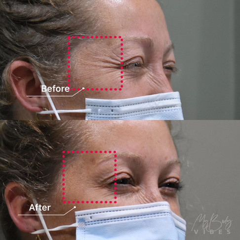 crows feet anti-wrinkle