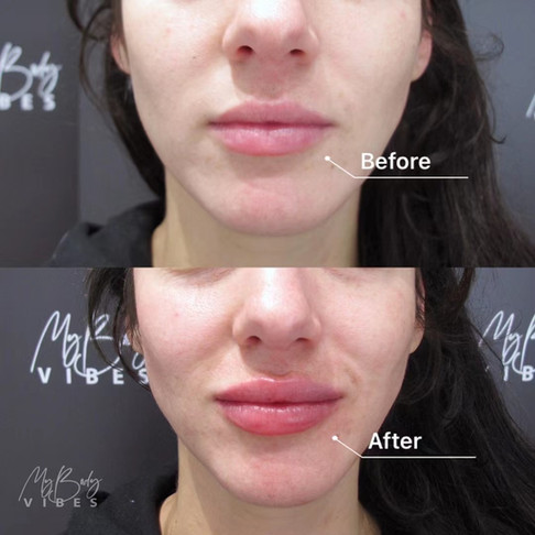 lip filler