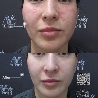 hydra facial
