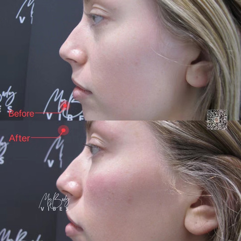 cheek filler