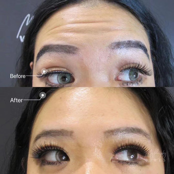 anti-wrinkle injection- forehead