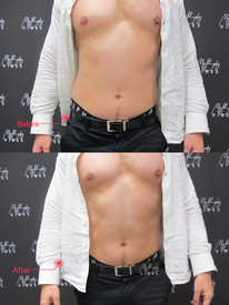 emshape on abdomen