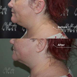 ulfit double chin reduction