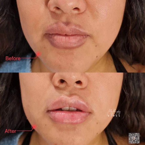 lip filler