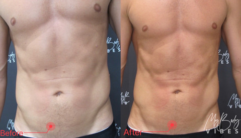 emshape on abdomen