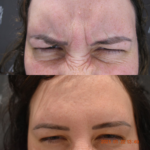 anti wrinkle frown lines