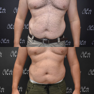 fat freezing on abdomen