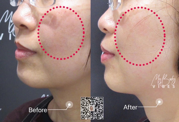hydra facial