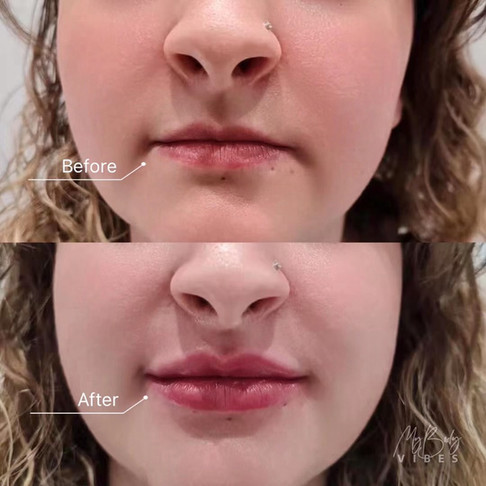 lip filler
