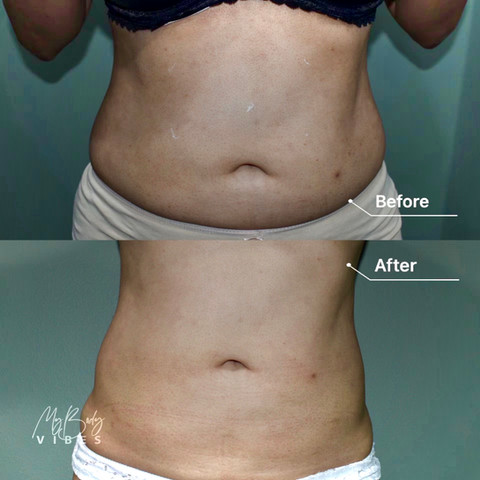 fat freezing on abdomen