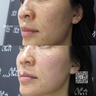 picolaser pigment removal