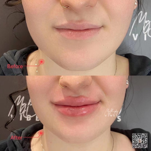 lip filler