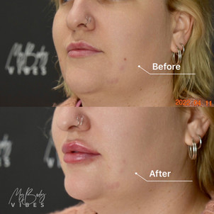 lip filler.jpeg