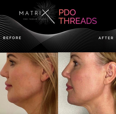 Before and After PDO Thread Lifting - Image 1