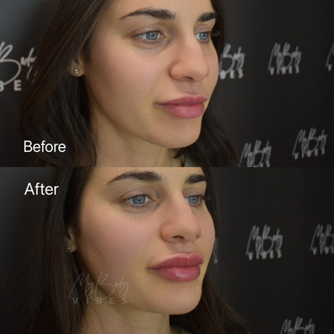 lip filler