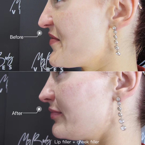 cheek filler