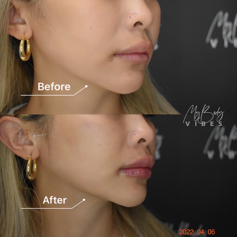lip filler