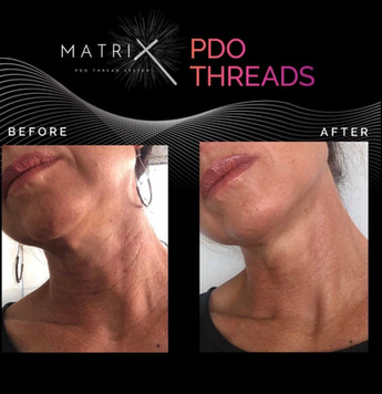 Before and After PDO Thread Lifting - Image 2