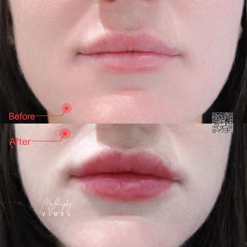 lip filler