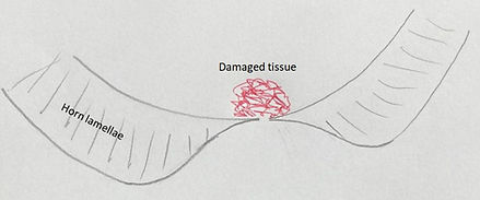 Schematic drawing af a nail lesion after pedicure: the aim of the pedicure is to create space and to make the edges as thin as possible