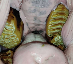 Moderate malposition of the left upper molars associated with decreased food intake